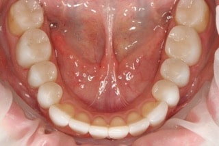 OVC3 case study after with crowns
