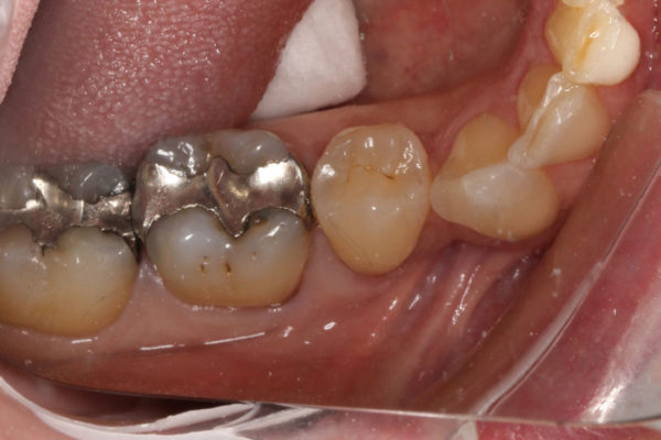 OVC3 Case study cracked tooth syndrome before from top