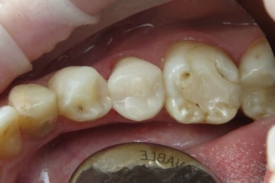 OVC3 Case Study Endo Treated Pre-Molar After From Top