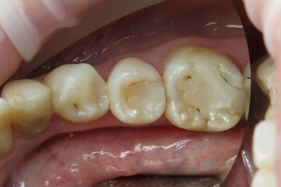 OVC3 Case Study Endo Treated Pre-Molar Before From Top