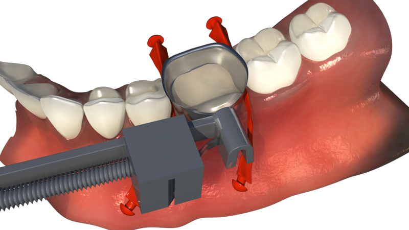 One-Visit-Crown-OVC3-Matrix-Band-&-Stretch-Wedge OVC3 Matrix Band & Stretch Wedge
